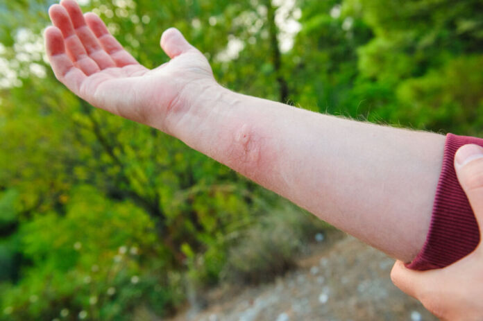 Ein Mann hält seinen rechten Arm mit hochgezogenem Ärmel in die Kamera und zeigt einen rötlichen, dick anlaufenden Stich eines Insekts, einer Wespe oder einer Biene.